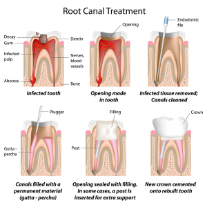 Root Canal garland Texas