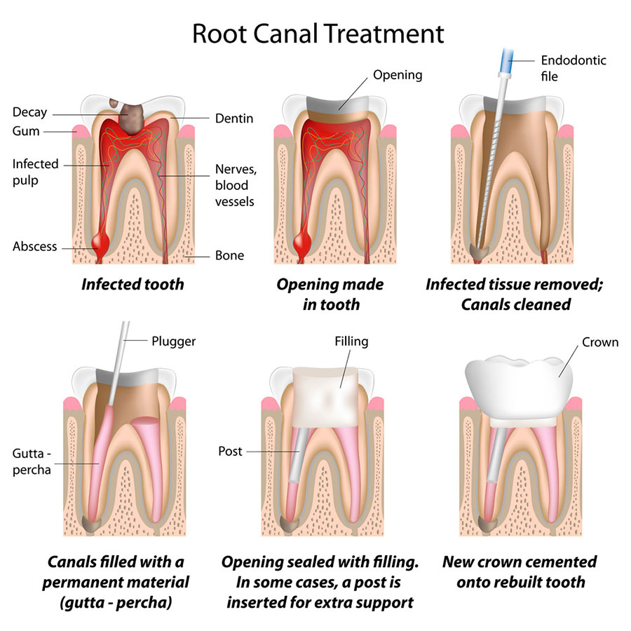 root canal Garland