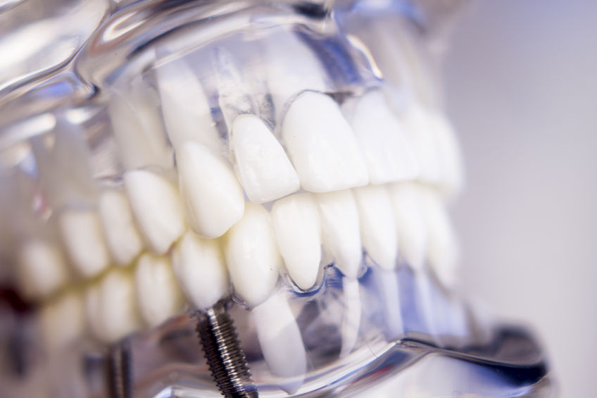 Dental implants Garland