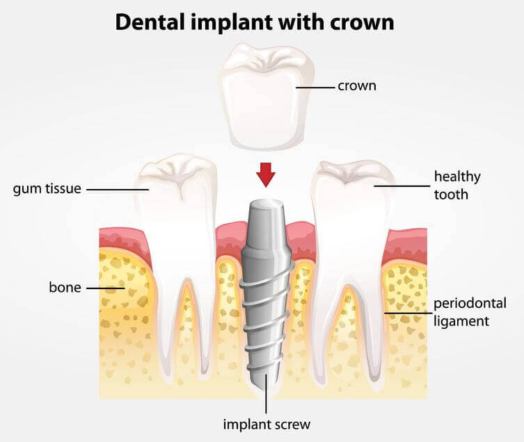 Dental implant Garland