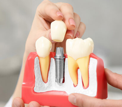 Why Choose Dental Implants Over Dentures? Exploring the Benefits