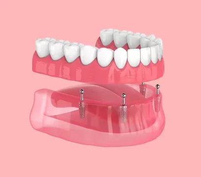 All-on-4® Dental Implants: Your Permanent Solution for Missing Teeth