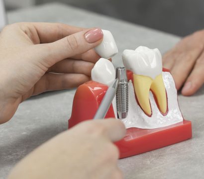 The Healing Process After Dental Implant Placement